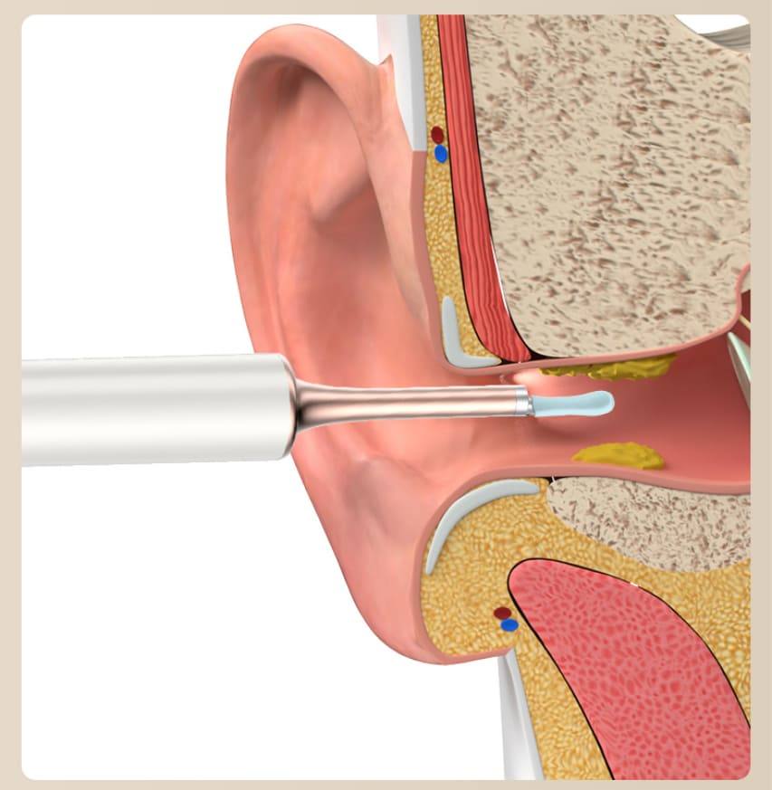 sredstvo za uklanjanje ušnog voska čišćenje uha